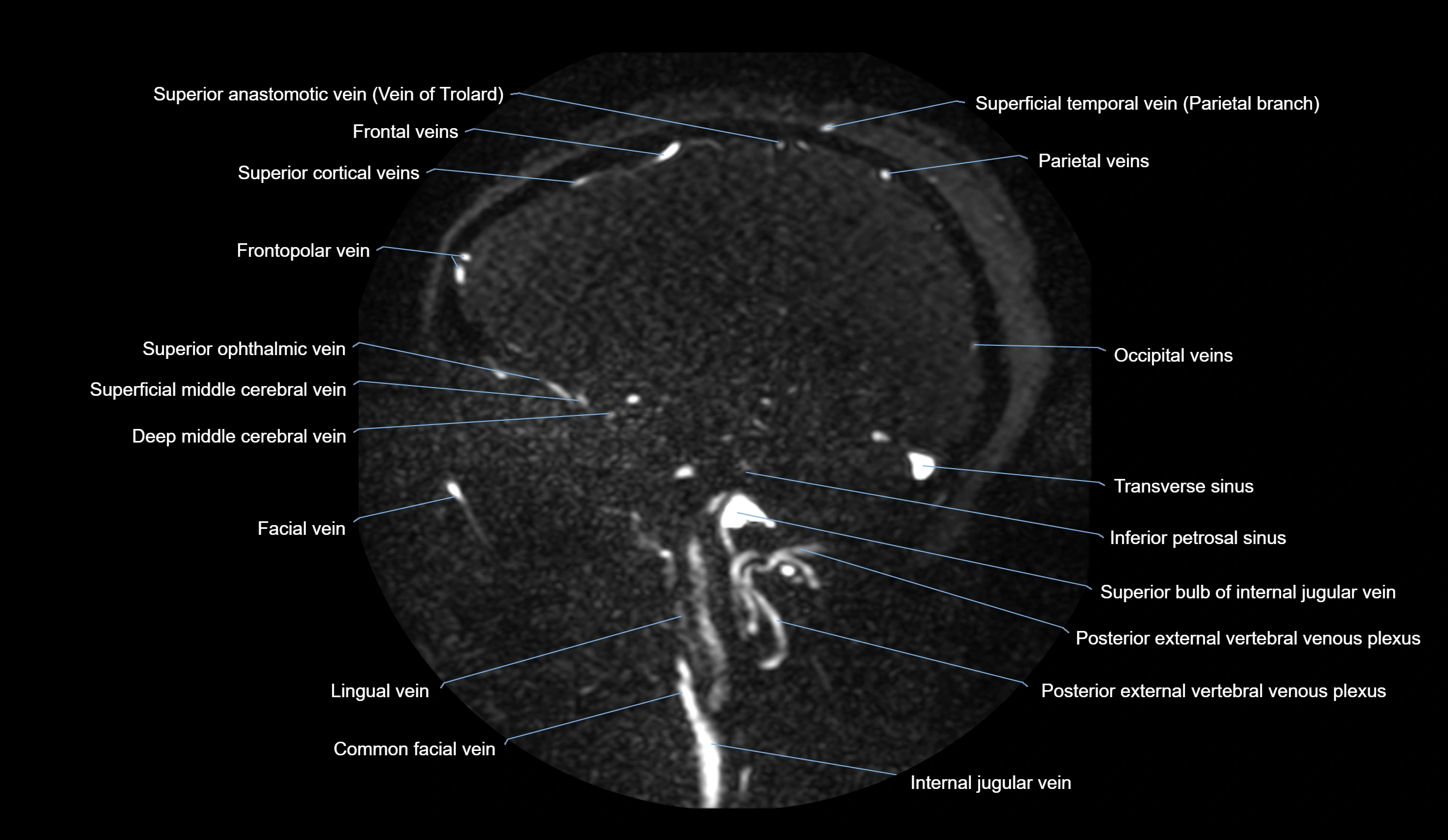 MRV brain sagittal anatomy 3T MRI labelledimages -00030.webp